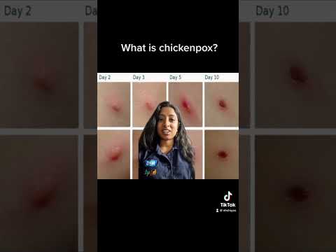 What is chickenpox?