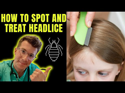 How to spot and treat Head lice (nits) | Doctor O'Donovan explains...